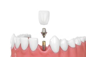 Dental Implants in Woburn, MA | Four Corners Dental Care