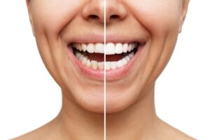 Dental Veneers in Woburn, MA | Four Corners Dental Care