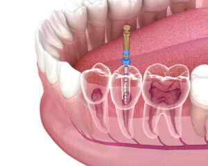 Root Canals in Woburn, MA | Four Corners Dental Care