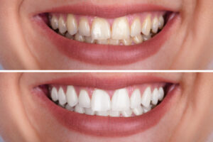 Teeth Whitening in Woburn, MA | Four Corners Dental Care